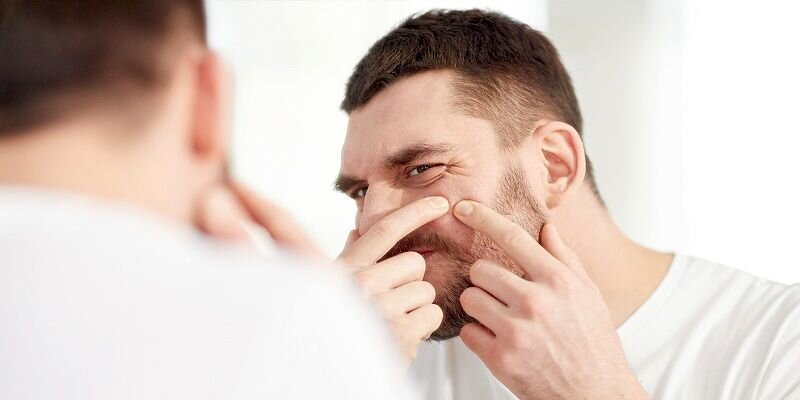 علت اصلی جوش چرکی چیست ؟ ؛ درمان خانگی جوش های چرکی و دردناک