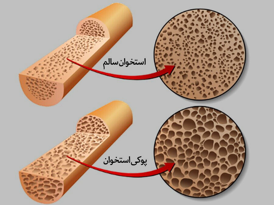 چگونه به پوکی استخوان مبتلا نشویم؟ | روش اصلی تشخیص پوکی استخوان